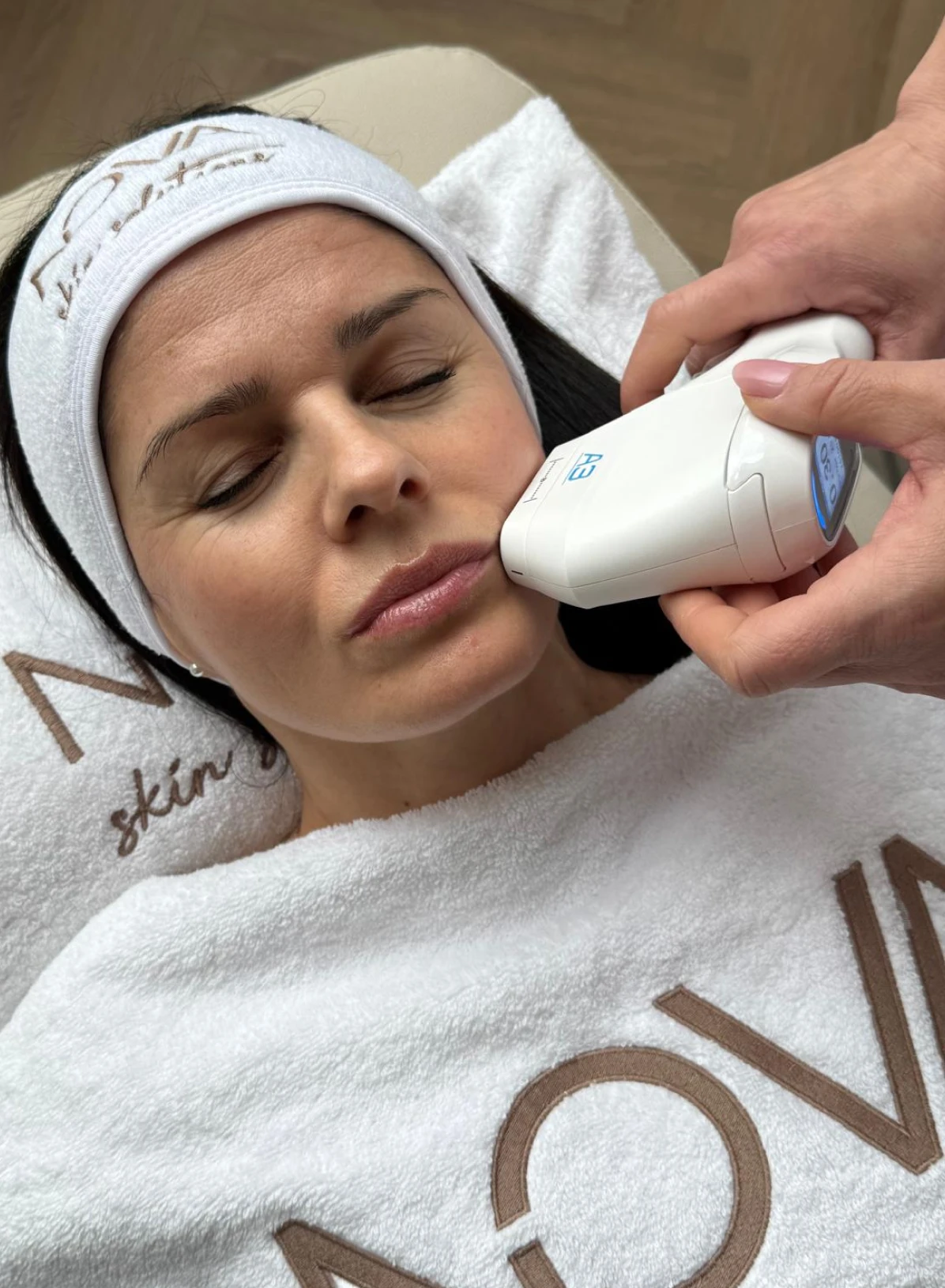 Potenza RF-microneedling behandeling van het gezicht